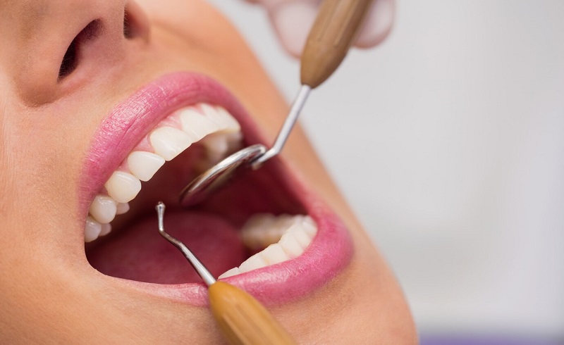 All You Need To Know About Teeth Whitening, A Guide By B-Well.