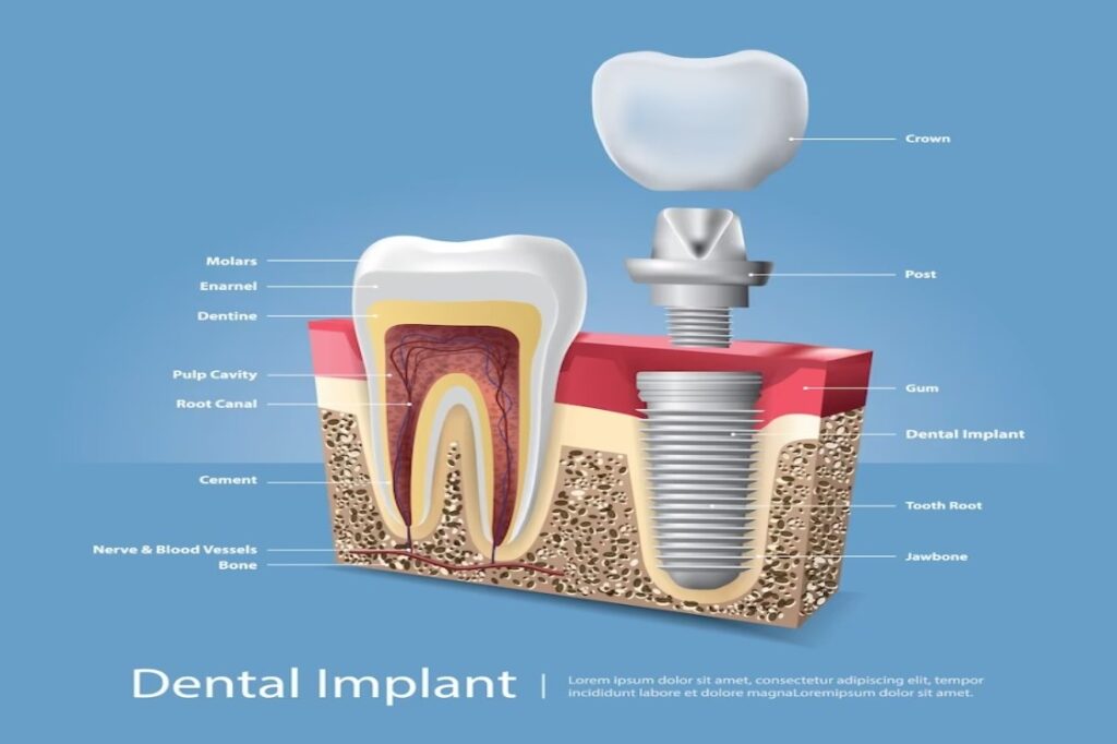 The Longevity of Tooth Implants: A Comprehensive Guide