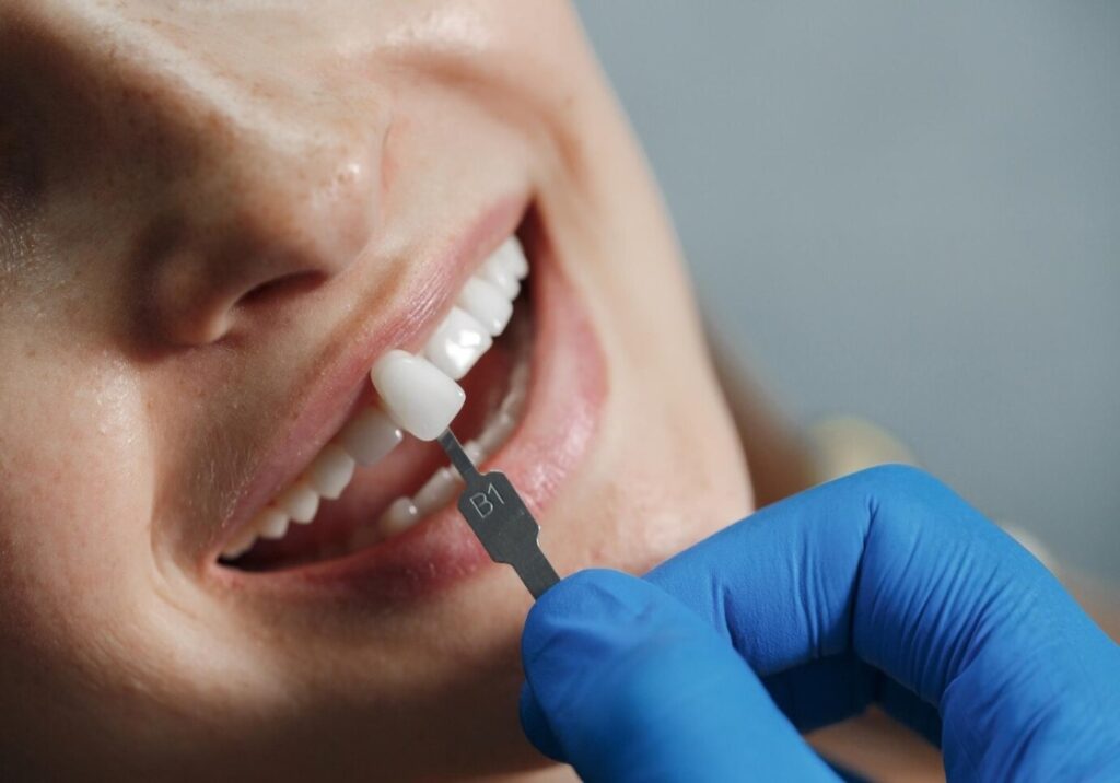 A Comprehensive Guide on How Dental Veneers Transform Your Teeth