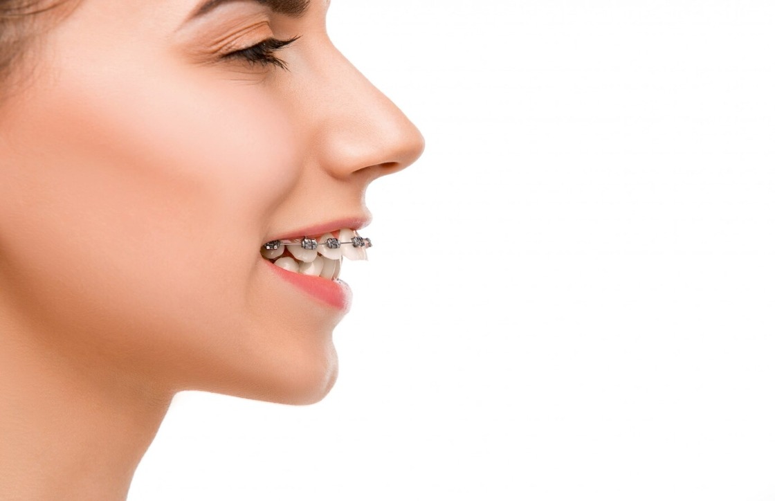 Perfecting Profiles: A Comprehensive Guide to Orthodontic Care