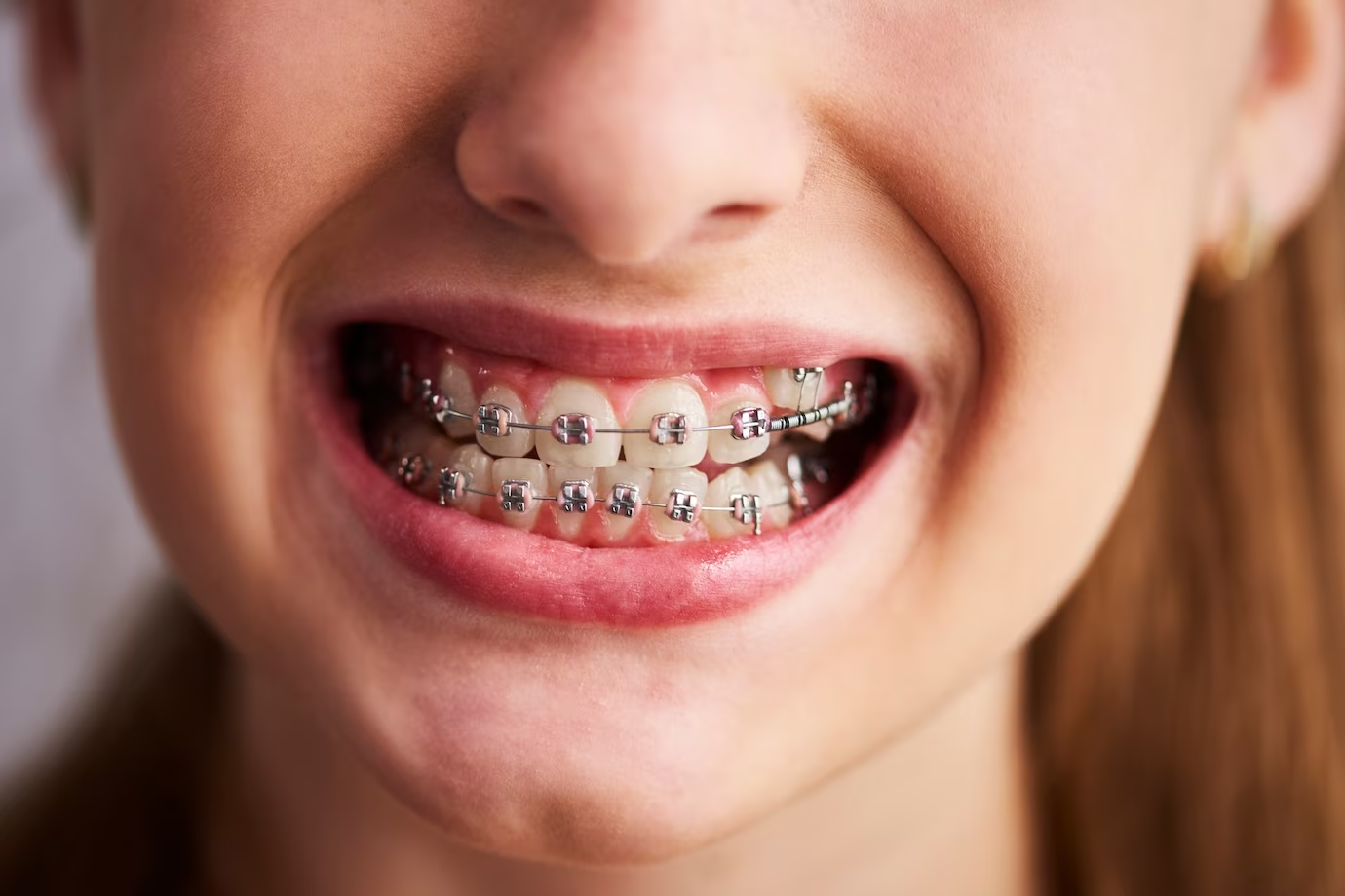 Exploring the Best Types of Teeth Braces for Adults in Dubai